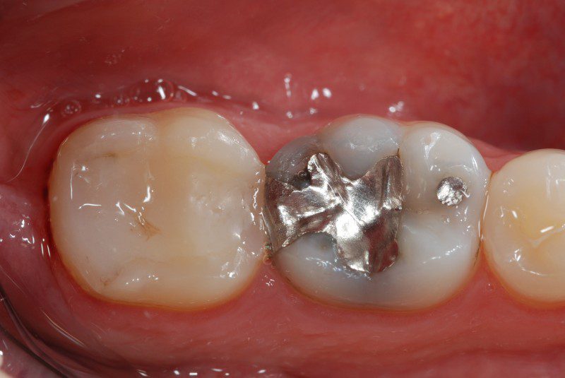 Molari inferiori con restauri incongrui