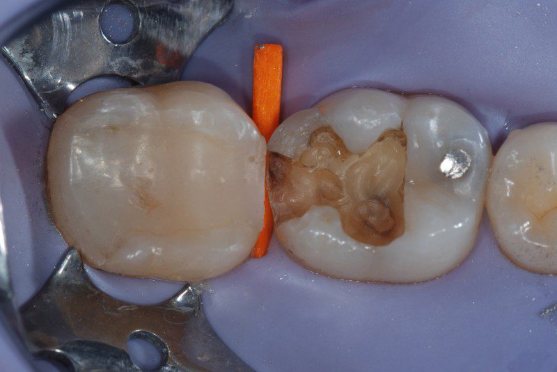 Rimozione e preparazione definitiva degli elementi dentari