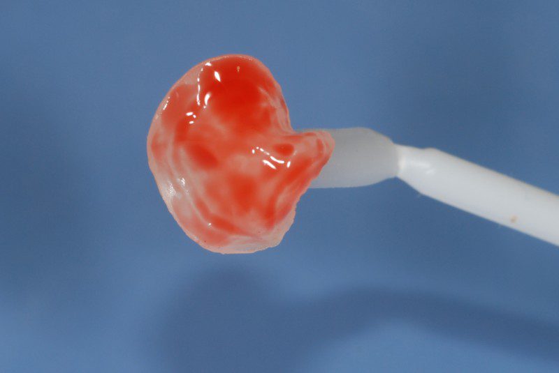 Isolamento dei denti con la diga di gomma