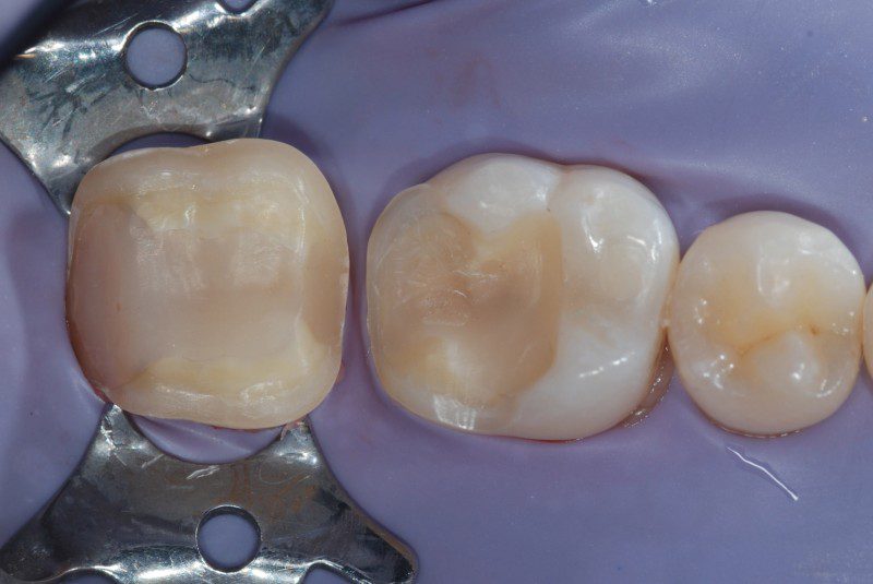Rimozione dei vecchi restauri
