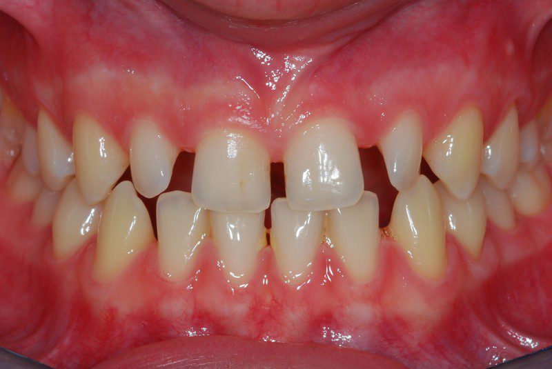 Elementi dentari frontali