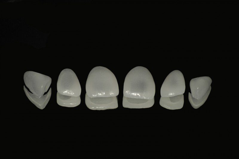 Faccette in ceramica